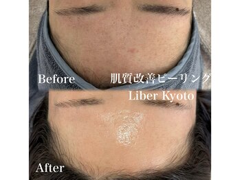 リベルキョウト 京都駅前店(Liber Kyoto)/肌質改善ピーリング