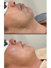 みんなのLED脱毛/男性・ひげ脱毛施術