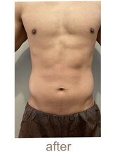 ブリス エナジーアンドサロン 福岡薬院店(bliss energy&salon)/エナジー（マシーン）　after