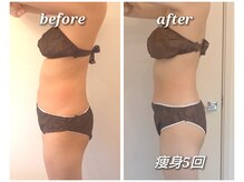 フェリーチェ(felice)/施術例／ウエスト引き締め