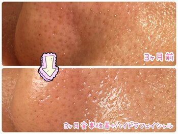 ハレハダ(HAREHADA)/毛穴洗浄と食事改善で毛穴小さく