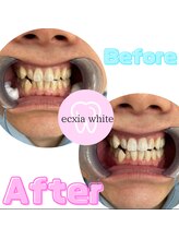 エクシアホワイト 広島袋町店/ホワイトニングビフォーアフター