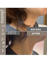 コア(Koa)/プラズマショットパーツ