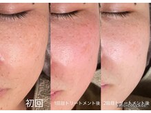 オリス(Oris)/グリーンピールbefore/after