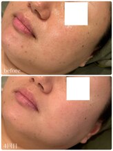 クラン 森ノ宮店(Clan)/ハーブピーリング　30代女性