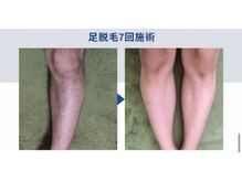 タッチの雰囲気（最新IPL×SHR搭載マシン導入で美肌ケアしながら全身脱毛★）