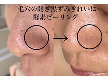 毛穴のでこぼこ黒ずみ開き改善、つるつるなめらかに
