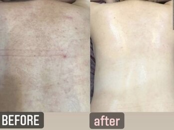 ビアス(Biasu)/背中毛穴ケア☆