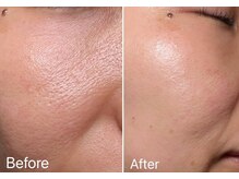 アプローズ(APPLAUSE)/エクソソーム導入で細胞を活性化