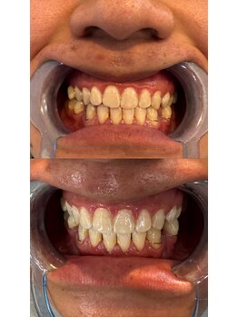 アレッド 大阪店(ared.)/お得にホワイトニング