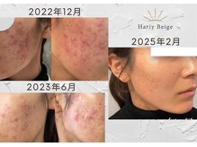 ハリーベージュ(Hariy Beige)の雰囲気（【月2回美容鍼＋ポレーション】肌質改善◎オーダーメイド施術）