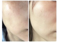 那賀洋子式 顔ジム 大分戸次店/小顔はスキンケアと