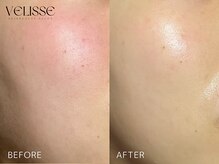 Velisse 表参道店【ヴェリス】《毛穴/肌質改善/ハーブピーリング/ニキビケア》/
