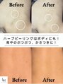 ベル 岡山京橋(Belle)&nbsp;背中 ニキビケア