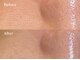 ソルニコン(Solnikon)の写真/毛穴・ニキビ改善で叶う憧れの韓国肌♪肌質別・オーダーメイドハーブピーリングが人気［毛穴/ニキビ/小顔］