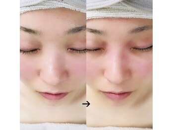 美助(bisuke)/高鼻矯正・美鼻施術のお写真