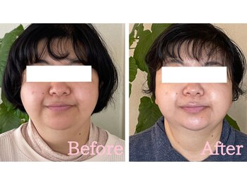 小顔矯正サロン ブルーム/施術3回ビフォーアフター