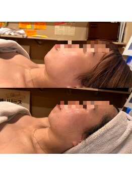 トトノエル(TOTONOEL)/小顔筋膜リリース