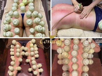 カメリー座薫 大阪上本町本店の写真/【吸い玉カッピング☆痛いけど痩せる!疲れもとれる】全身(背面)つけ放題￥7980◇1箇所から選べる¥4180も