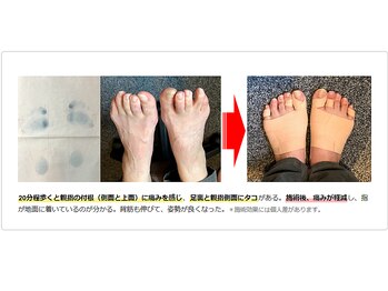 レメディ/外反などの足のトラブル