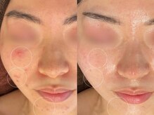 エヌエースキン 北谷店(NAskin)/ハーブピーリング｜ニキビケア