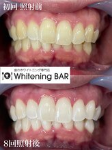 ホワイトニングバー 町田店/4来店8回目ビフォーアフター