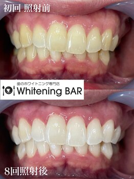 ホワイトニングバー 町田店/4来店8回目ビフォーアフター