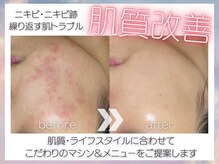 本気の肌質改善！BioPeelのハーブピーリングを導入しています♪