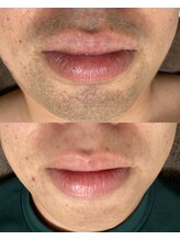 ジェムの森/ひげ脱毛 before after写真