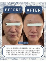 ≪毛穴洗浄肌質改善/小顔たるみケアSalon≫　泡のきもち【12/1 NEW OPEN（予定）】/スペシャルエイジングケア