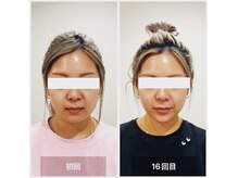 ヴィーライン 札幌大通院(VeLine)の雰囲気（お悩みに合わせた形状記憶美容鍼）
