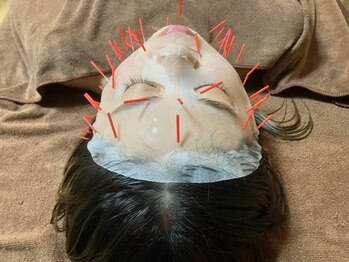 真輝/13 &nbsp;美容鍼