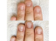 ちび爪、噛み爪、2枚爪のケアもお任せください♪