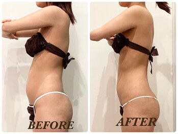 プリマ 栄店(Prima)/【2回施術】　BEFORE＆AFTER