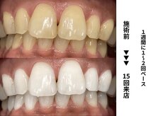 ホワイトニングセンター 長野駅前店/【長野市ホワイトニング】