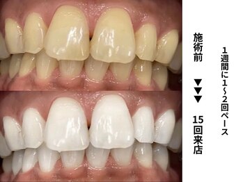 ホワイトニングセンター 長野駅前店/【長野市ホワイトニング】