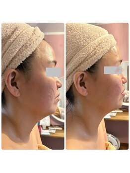 エルブラン(Herb ame)/首コリ悩みの方にも小顔脂肪分解