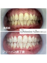 ホワイトニングサロン 京都烏丸店/ホワイトニング施術例