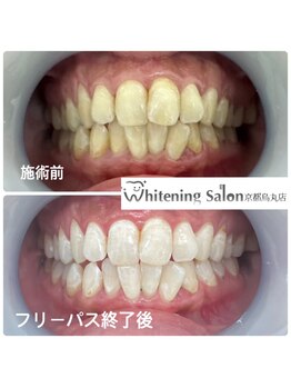 ホワイトニングサロン 京都烏丸店/ホワイトニング施術例