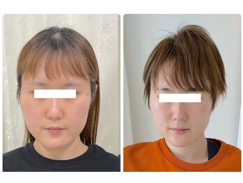 ワイサロン(Y salon)/【小顔症例】コルギ12回目