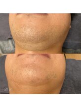 オンセ(once)/顔脱毛/全身脱毛