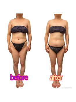 スマイルボディ つぼの森 加治木店(Smile body)/ラジオ波☆全身