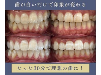 グリッター ショウナン(glitter.SHONAN)の写真/ナチュラルな白さであなたの笑顔がもっと輝く！第一印象がガラッと変わるセルフホワイトニング♪メンズも◎