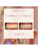 プラスビー 2号店(+b)/ホワイトニングビフォーアフター