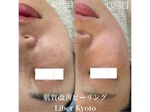 リベルキョウト 京都駅前店(Liber Kyoto)/肌質改善ピーリング