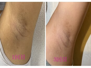 ベル(Belle)/キッズ【セレクト】選べるパーツ