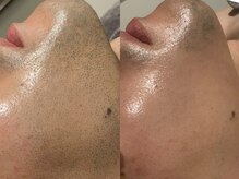 バタフライ 津田沼店(Butterfly)/美顔ヒゲ脱毛