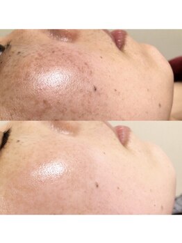 リフィックスビューティサロン(LIFIX)/【リアボーテハーブ】ビフォアフ