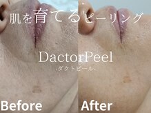 メイプル(Maple)/60代女性/お悩み→口元のシワ