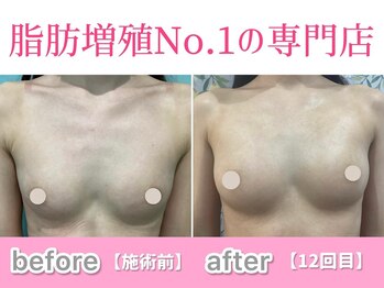 サラエクセレント 新宿(SARA EXCELLENT)の写真/今年の夏こそ変えたい方へ！！自信あふれるバストラインへ◎「もっと早く来たかった」の声続出中♪